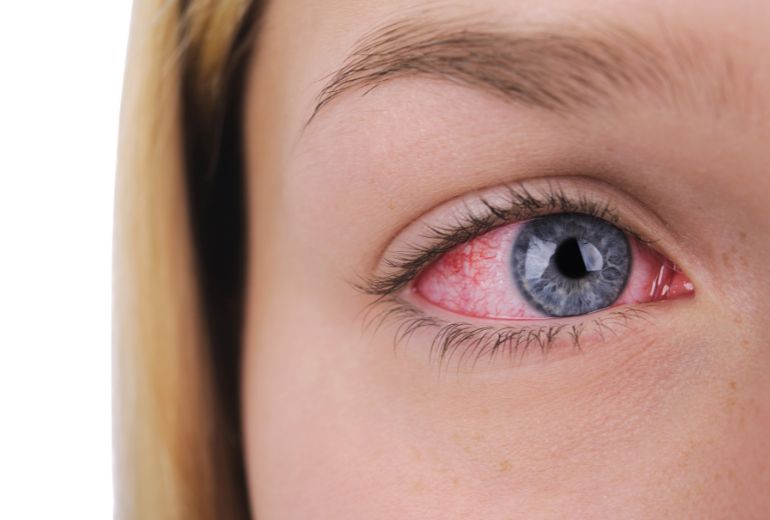Alergie oczu