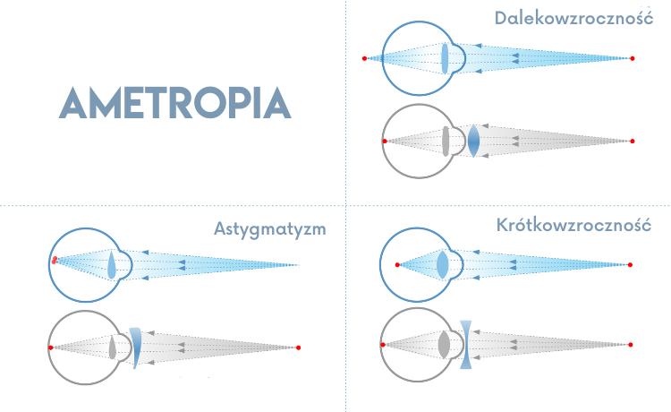 Emmetropia a ametropia porównanie tabela