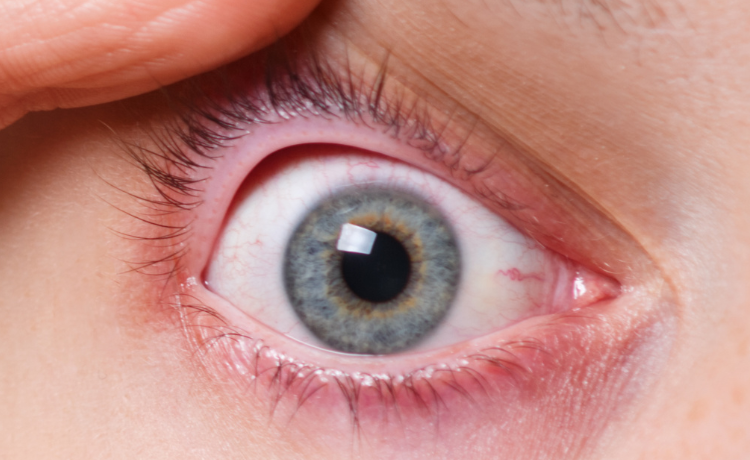 Dlaczego gruczoły Meiboma są istotne dla zdrowia oczu