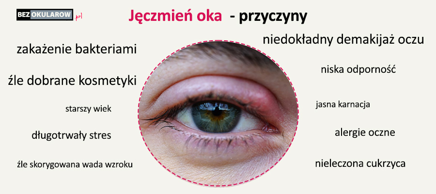 Jęczmień oka przyczyny infografika