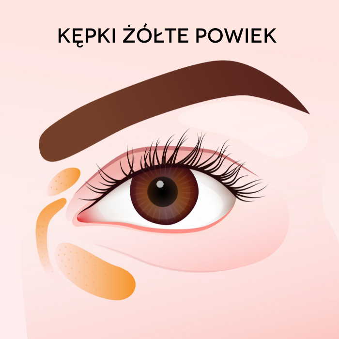 Co to są kępki żółte powiek?